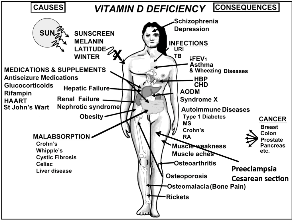 vitamin-d-deficiency-causes and consequences.png